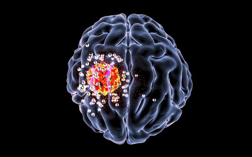 سرطان-الدماغ-ثورة