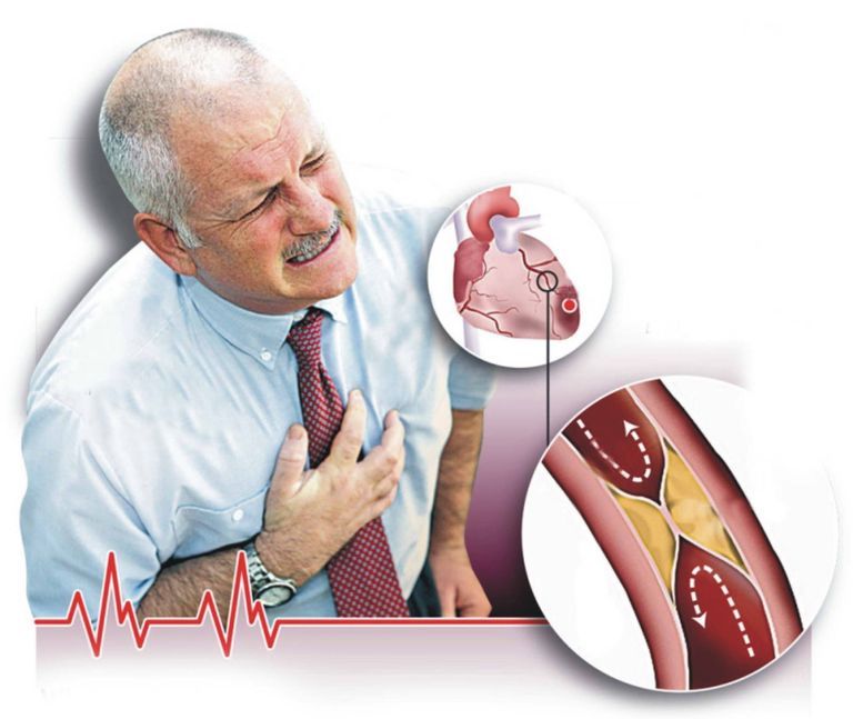 197-102654-atherosclerosis-8-causes-increase-infection-2
