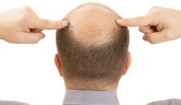 وداعاً للصلع! مصل ثوري لإعادة نمو الشعر خلال 20 يوماً فقط