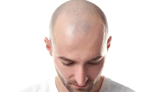 اختراق علمي.. مكون شائع في الآيس كريم يمنع تساقط الشعر