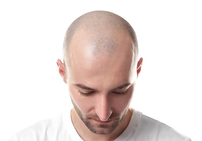 understanding-male-pattern-baldness-en-ae