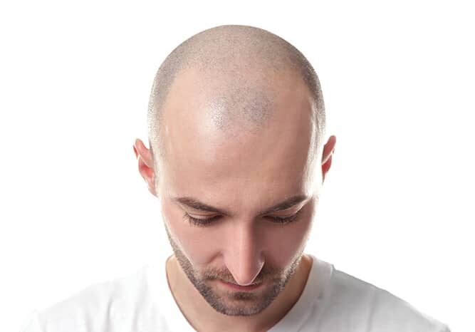 understanding-male-pattern-baldness-en-ae